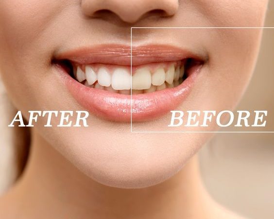 Top 10 Teeth Whitening Cheras